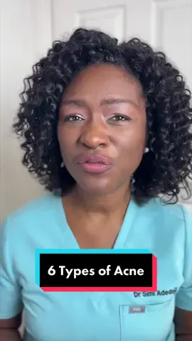 6 Types of Acne Spots. Which one(s) do you have?? 1. Blackheads 2. Whiteheads 3. Papules 4. Pustules 5. Nodules 6. Cysts Disclaimer: Not medical advice, for educational purposes only. Youtube.com/DrSimiAdedeji #acne #acne #skinacne #skin #skinhealth #acnespot #acnespots #acneskin #acneproneskin #acneeducation #blackheads #pimplesandblackheads #whiteheads #papulesacne #papules #pustules #nodules #nodules #cysticacne #cyst #cysts 