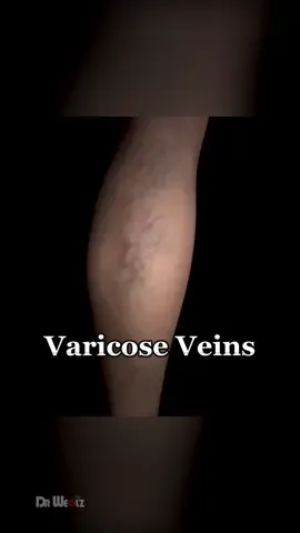 Varicose Veins #3d #animation #varicoseveins #leg #veins #bloodclot 