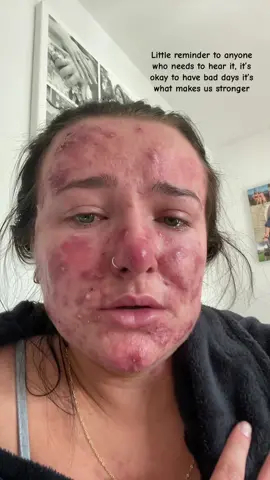 This morning i couldnt help but cry my acne is giving me so much pain, its so inflamed its hard to wash my face without it hurting. But its not always going to be like this ive got to stay positive❤️ its okay to have bad days but you gotta pick yourself up! My messages are always open if anyone wants to talk🫶🏼 #acnepositivity #acneproneskin #acne #acnejourney #acneskin 
