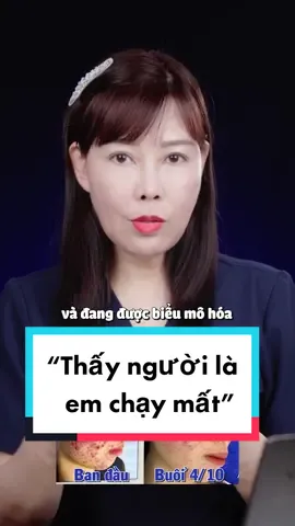 “Thấy người là em chạy mất” - ca mụn nặng từ Quảng Bình lên Hà Nội #dcgr #fypシ #trimun #bacsilaha #goclamdep #goclamdep 