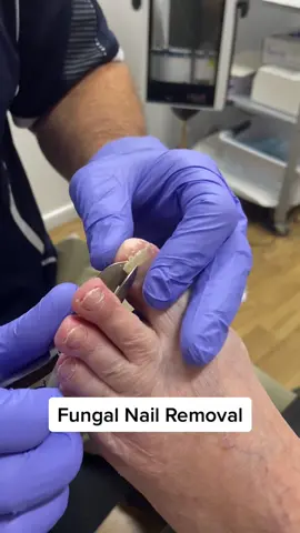 Funfal nail removal by podiatrist #fungal #fungalnail #ergonx #docpods #satisfying #podiatry #podiatrist #australia