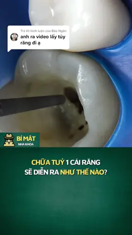 Trả lời @Bảo Ngân cách mà người ta chữa tuỷ đây sao? #răng_miệng #niengrang #xuhuong #chamsocrangmieng #fyp 