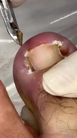 #viral #podologo #podologia #unhaencravada #podologa #unhas #videosatisfatorio 