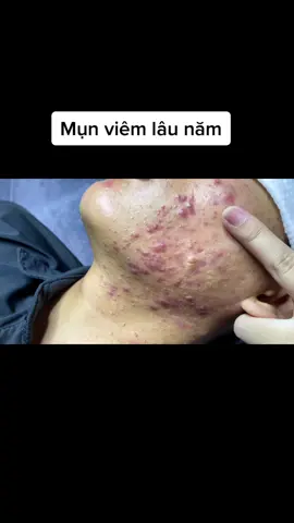 Mụn viêm và nặn mụn ẩn #NhatBangSpa #LearnOnTikTok #nanmungovap #review_nặn_mụn  #nặnmụngòvấp 