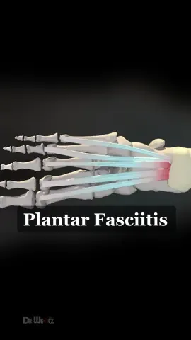 Plantar Fasciitis #feet #foot #plantarfasciitis #3d #animation 