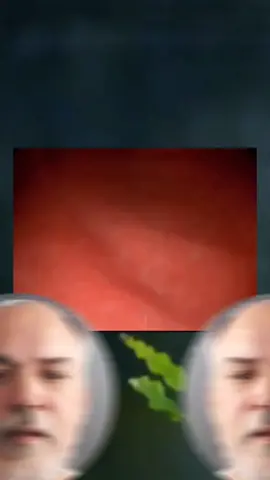 Esta bactéria é malvada. #endoscopiadigestiva  #hpylori  #cancer 