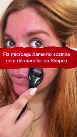 💉🩸 Fiz microagulhamento com o dermaroller da Shopee 💉🩸.                          #microagulhamento #dermaroller #dermarolling #shopee 