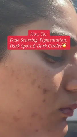How to perfect your complexion - fade scarring, pigmentation, dark spots/circles, uneven skin tone & bring back your skin’s natural glow!🌟 #foryoupage #foryou #trending #skin #skincare #clearskin #acne #acneskin #asiangirl #desi 