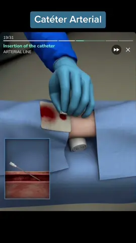 Catéter arterial #medicina #cateter #surgery #fypシ #medicaltiktok 