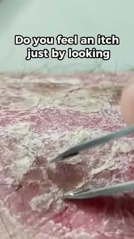 Clear Up Your Skin- Tips for beating Eczema#eczema #eczematreatment #skincare #itchyskin #skincondition #eczemaonhands #eczemascratching #dermatology#skinhealth #allergies #usa #tiktok #philippines #viral 