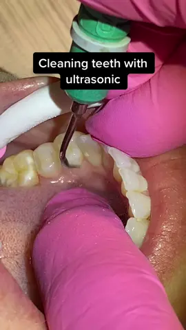 Cleaning teeth with ultrasonic #ultrasoniccleaner #teethcleaning #dmdomg #teeth #dentalappointment 