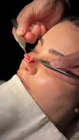 Thick skin rhinoplasty and best result🔥🔥 how we make nose tip thinner👉👉👉#burunestetiği #barbienose #erdiozdemirclinic #nosejob #öneçıkar #turkey #temporallifting #istanbulburunestetiği #tiktokkeşfet #tiktoktürkiye #temporallifting 