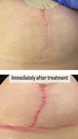 This is before and immediately after a Scar Camouflage treatment. The area will have some redness, some inflammation with some pin point bleeding specks. Not to worry, this is normal and it’s the the start of the wound healing process! This will fade and the colour will go back to normal skin colour 😁🫶😁 #scar #scarremoval #scarrevision #needling #microneedling #skin #tattoo #scarremover #breastlift #scarcamouflage #scarcamouflagetattoo 