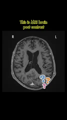 Spot diagnosis on MRI brain. What other lesion should you look for in this case? Check out the answer here @Dr Azku | Radiologist  #radiology #medtiktok #imagingdiagnosis #radiologicaldiagnosis #frcr #medstudent #vascularmalformation #magneticreasonanceimaging #auntminnie 