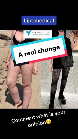 3 years after lipedema surgery with Lipemedical . How would you describe this change? . Before-after of our patient @Gladys Seara  #lipedema #lipoedema #lipödem #lipedemalife #lipo #lipedemafighter #lipp #lippylegs #lipemedical #lipedemasurgery #lipoedemefrance #lipededemauk #lipedemaireland #lipedemalegs #lipedemaawarenes #lipedemagirl  . Online consultations: info@lipemedical.com