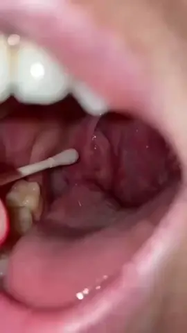 Viem Amiđan hay hốc mủ hay còn gọi la sỏi Amiđan.bệnh nặng gây sưng dau,khó nuốt mệt mỏi,chán ăn. Ho,đờm,sốt va rất la hôi miệng..lâu lâu ngày càng biếm chứng phức tap và khó điều trị.ai bi ib e trị cách trị dứt điểm bằng bài thuốc hoàng toàn tự nhiên không tái phát nhé.#viemhongmantinh# #viemhonghat-viemamidan#viemhong# #xuhuong#trending#capcut