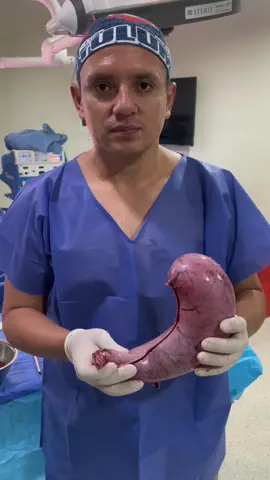 La Manga Gástrica es la cirugía que más se realiza en el mundo para el tratamiento del exceso de peso 🤩 👏🏻  Consiste en retirar el 80% del estómago dejando un pequeño estómago tubular, la cirugía permite el control del apetito al retirar la hormona ghrelina lo que te produce la ansiedad por comer 🍽 y tener un Estómago pequeño para disminuir la cantidad de ingesta de alimentos.  Se realiza bajo técnica laparoscópica mínimamente invasiva, solo requieres una noche de hospitalización y en pocos días estarás 100% recuperado 💪🏼✨ 📲Escríbeme por interno para brindarte más información y decirle adiós a la obesidad y enfermedades derivadas  #mangagastrica #cirugiabariatrica #bariatrica #gastricsleeve #ecuador #reels 