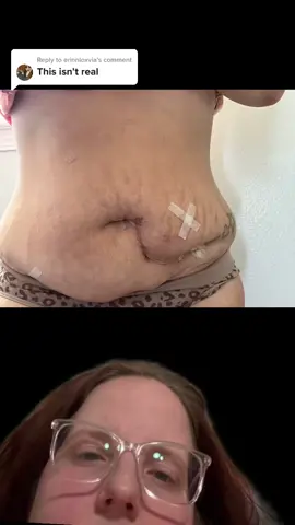 Replying to @erinnloxvia #greenscreen yeahhhh honey it was real. #endometriosis #endometriosissurgery #endometriosisawareness🎗️ #endometriosisexcision #ovaryremoval #oophrectomy 