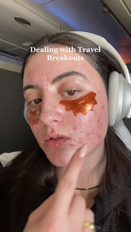 Put a 🙋🏻‍♀️ if you breakout while travelling? @Bubble had me covered🥰 can you tell how much I’ve been using this product by the deforming packaging 🤣 #acnepositivity #acneskin #bubbleskincare #acnetreatment #skincare #ad 