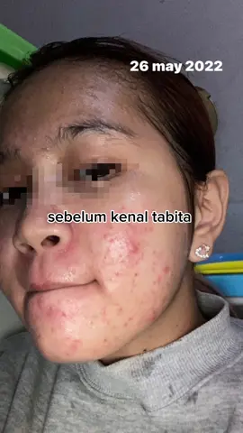 Udah gak insecure lagi🥲🥹 #tabita #tabitaskincareoriginal #tabitamalaysia #tabitaskincare #tabitaoriginal #skincare #GlowUp #glowingskin #glowingskinroutine #fyp #fypシ #foryourpage #fypsounds 