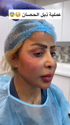 قبل وبعد … #عمليات_تجميل #الدكتور_يوسف_خالد #شد_الخد #نحت_الذقن #سحب_العين 