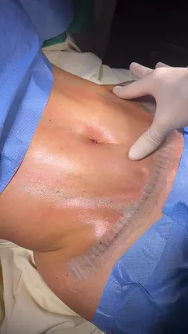 #abdominoplasty #abdominoplastia