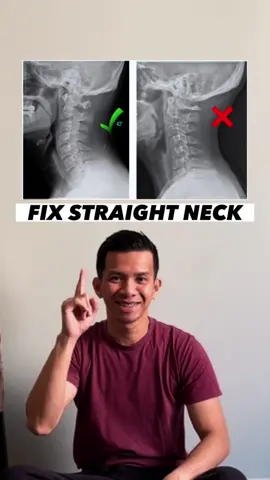 Cervical kyphosis, or military neck, occurs when your cervical spine is straight or curves toward your front instead of its natural curve. Fix it with these exercises! #cervical #khyposis #spondylosis #neckpain #neckpainrelief #straightneck #militaryneck #foryou #foryoupage #physicaltherapytiktok #physicaltherapylife #qatar #qatartiktok #philippines🇵🇭tiktok #philippinestiktok 