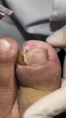 #ingrowntoenail #ingrownnail #ingrown #ingrowntoenailremoval #footpain #fyp #ingrowntoenailsurgery #stubborn #granuloma  #satisfying #relaxing #viralvideo @FootWorks Relaxing 
