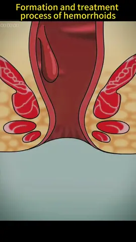 #hemorrhoids #formation #treatment #foryou #fypシ