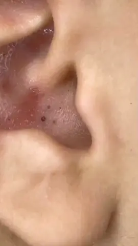 #pimple #acne #pimples #blackheads #pimplepopping #skincare #blackhead #pimplepopper #whiteheads #pimplepoppers #whitehead #blackheadextraction #blackheadremoval #cyst #pimplepop #drpimplepopper #pimplesremover #zit #pores #skin #whiteheadextraction #drsandralee #beauty #acnetreatment #cystremoval #zits #whiteheadremoval #jerawat #skincareroutine #pimpleremover