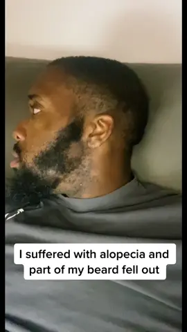 I suffered with alopecia and now my beard is thick again thanks to @Organichairoids  #fyp #fypシ #viral #beardlookchange  #bearded #beardgang #trendingtiktok #beardstyle #hairtok #viralvideos 