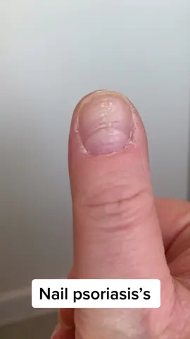 Nail psoriasis causes ridges on the nail ans cause think skin to build up around the nail that I annoyingly have to cut with nail clippers! #psoriasisawareness #psoriasis #beautiful_psoriasis #nailpsoriasis 