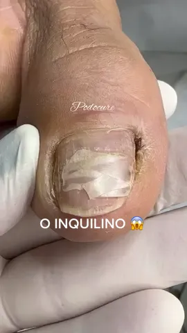 #TikTokMeFezAssistir #ingrowntoenail #satisfying #podocure #unhas #podologia 