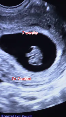 Dialn soo laa laabtay ayey laheyd lkn hada alx.. #drcadaani #ultrasound #pregnant #somalitiktok #drcadani #viral #for 