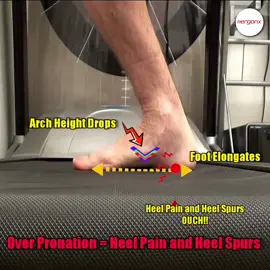 Over Pronation can cause Heel Pain and Heel Spurs  - Support your feet with orthotic insoles to help to rest and heal your feet #ergonx #docpods #heelpain #pronation #overpronation #footpain #orthotics #orthoticinsoles #podiatrist