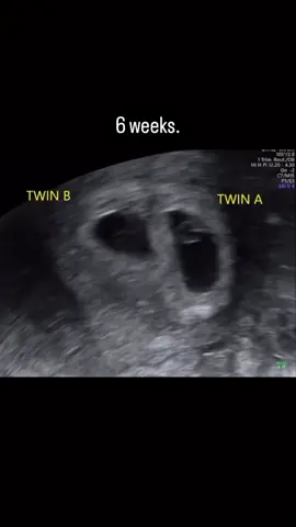 When you think Twin Season is over 😂😂 babies said NOPE! 👶🏻👶🏻 #twinmom #ultrasound #sonogram #babies #fyp #twinpregnancy 