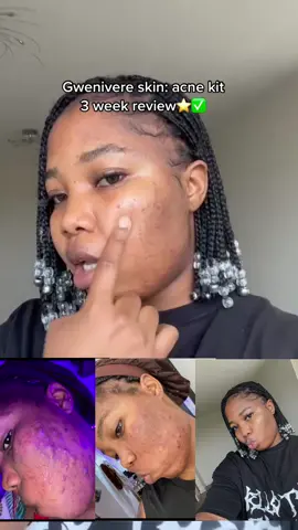 Amazing 3 week acne kit review🔥✅ #gwenivereskin #gwenivereskinacnekit #acnetreatment #acneskincareproducts #productsforacne #skincarebranduk #viralskincare #skincaretestimonials 