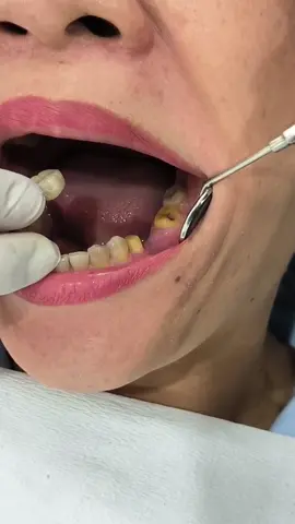 Bọc răng sứ cầu răng, mất răng 36  #shorts #nhakhoa #bocrangsu 