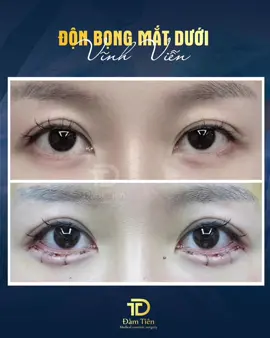 Tạo hình bọng mắt cười vĩnh viễn #bongmatcuoi #damtien 