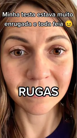 Mais uma cliente SATISFEITA. Parabéns Alessandra pela evolução 😍💦. #botox #melasma #antirugas #reveravit