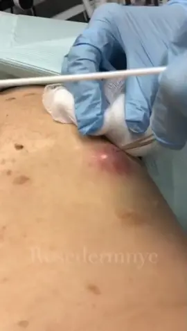 #asmr #fyyyyyyyyyyyyyyyy #espremerespinha #fly #viral #espinhas #satisfatorio #pimple #cisto 