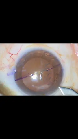 Cirurgia de catarata #cataractsurgery  #olhos #trenddosolhos #oftalmologia #catarata 