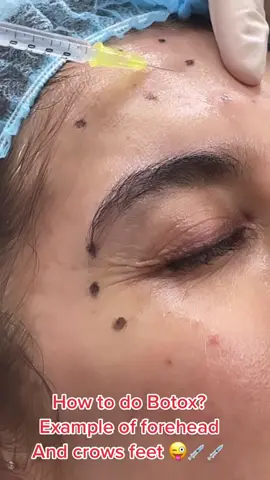 How do we perform Botox? 😎👌💉Here we have a clear example where you can see the way we mark the patient and how the Botulin toxin is injected!👌💉🩵#botoxdubai #uaedubai #drcristina #Botox #wrinkles #antiwrinkles #skin #skintreatments #crowsfeet #foreheadwrinkles 