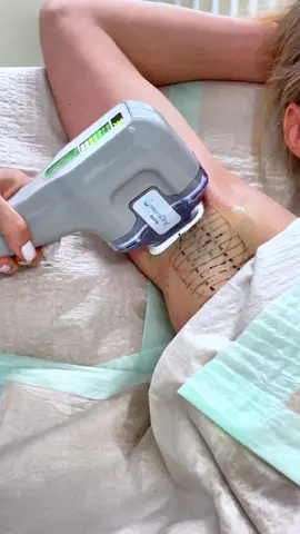 Unerwünschter #Achselschweiß? Millionen leiden unter lästigem Achselschweiß. 😓💦 Jetzt gibt es dauerhafte Hilfe ohne Operation bei uns in der Bodenseeklinik. Das Zauberwort heißt @miradry. Weitere Informationen unter: www.bodenseeklinik.de/schweissdruesenbehandlung ____ #gmedicalspa #naturalbeauty #noninvasivemedicine #noblood #getyoungandshine #fullbodyremodeling #shinyskin #tightskin #miradry 