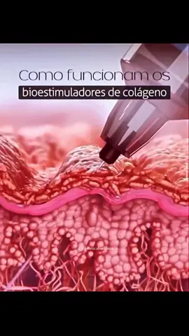 Bioestimulador de colageno  #bioestimuladordecolageno #esteticafacial #esteticacorporal #colageno #elastina #pelesaudavel #saude #fyrシ #esteticasp #biomedicina 