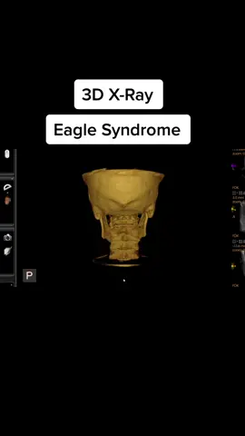Suffering with pulsatile tinnitus? Check this out! #eaglesyndrome #tinnitus #pulsatiletinnitus #xray 
