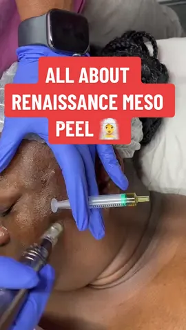The best treatment to tackle pigmentation, acne scarring, problematic skin and fine lines & wrinkles! #microneedlingtherapy #chemicalpeel #facialtreatment #tcatreatment #resurfacers #hyperpigmentationtreatment #skinblogger #skincarejourney #londonpeels #acnetreatment #estheticiantiktok #fyp #viral #pigmentationremoval #londontreatment #southeastlondonbased #microneedlinglondon #fyplondonuk #skincareprofessional #londonbeauty 
