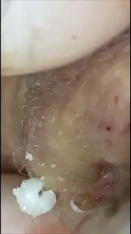 Old #blackheadsremoval #fyp #pt2 
