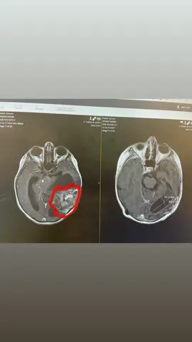 Looking at these pictures, just shows me how much progress we have made in 10 months! The left is her original tumor and the right is last week! The tumor bed is the super white area under the 60.6 mm measurement on the right. The area that is measured is still an extra pocket of spinal fluid that they are watching, but all in all, they are super happy with her scans! 💛 #camystrong #braincancerawareness #gogreyinmay #pediatriccancer #cancerwarrior #pxa #tumor #cancersucks #fuckcancer #hydrocephalusawareness #hydrocephalus #fightlikeakid🎗 #braintumor #braincancer #morethan4 #cancerawarness #cancermomsunite #cancermomlife #spreadawarenes 