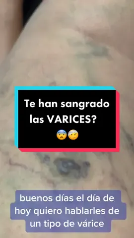 Que no te sangren las VARICES. Esto podemos hacer para prevenirlo. #varicesgrandes #escleroterapia #varicesenlaspiernas 